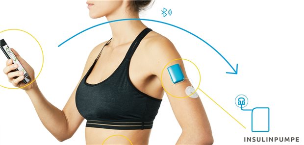 Gothaer: Künstliche Intelligenz soll bei Typ-1-Diabetes unterstützen Versicherte der Gothaer sollen künftig bei ihrem Diabetes-Management unterstützt werden.