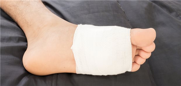 Versorgtes Fußulkus: Mechanische Druckentlastung des Geschwürs begünstigt die Heilung.