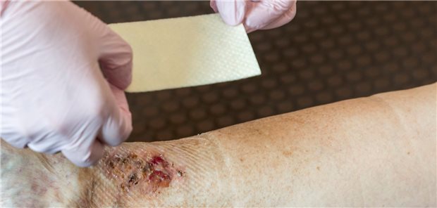 Viele Ärzte werden ihr Regime der modernen Wundversorgung umstellen müssen, wenn bestimmte Produkte aus der Erstattung fallen.