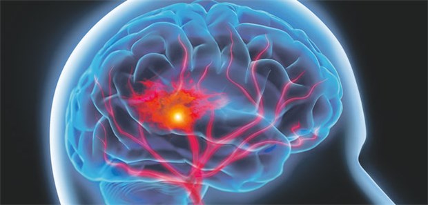Viele Patienten mit ischämischem Schlaganfall erleiden innerhalb eines Jahres einen weiteren Infarkt.