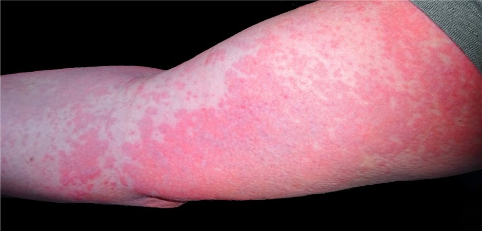 Hautausschlag Durch Antibiotika Was Tun www.aerztezeitung.de