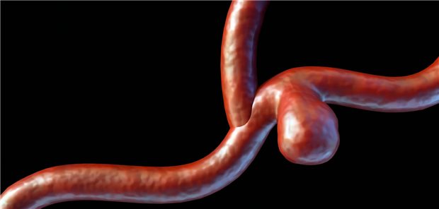 3d rendering of a saccular aneurysm, also known as a berry aneurysm, is a bulge that forms on the wall of a blood vessel in the brain