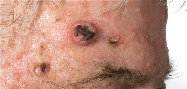 Vitamin A kann das Risiko für Plattenepithelkarzinome wie hier auf der Stirn eines Patienten um bis zu 17 Prozent senken.