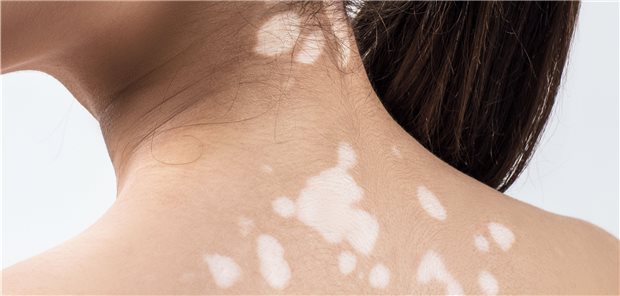 Erstmals Leitlinie zu Diagnose und Therapie der Vitiligo