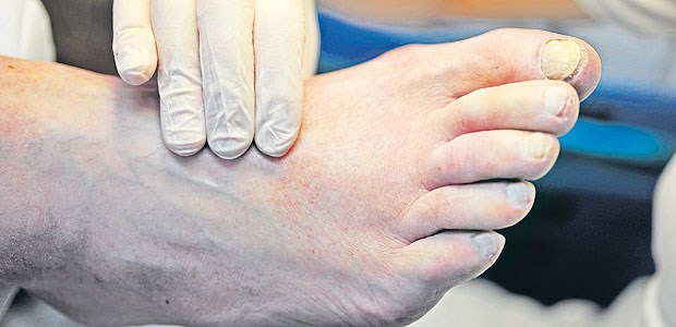Von Beschwerden in den Vorfußgelenken sind gerade Patienten in frühen RA-Stadien häufig betroffen.