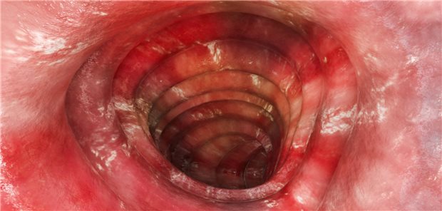 Von Colitis geschädigte Darmmukosa: Langfristig gilt es, eine Heilung der Mukosa zu erreichen.
