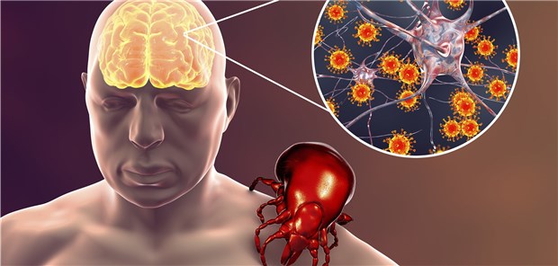 Drei neue FSME-Risikogebiete Von FSME-Viren befallene Neuronen im Modell.