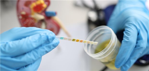 Ein Arzt führt einen Express-Urintest mit Indikatorpapier durch.