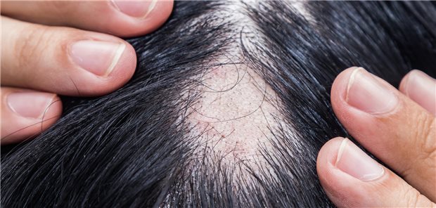 Von den mit 4 mg und 2 mg Baricitinib behandelten Probanden, die in Woche 52 bereits auf den JAK-Inhibitor angesprochen hatten, konnten 90,7 Prozent bzw. 89,2 Prozent einen SALT-Score (Severity of Alopecia Tool)   20 (entspricht   20 Prozent Verlust des Haupthaars) in Woche 104 beibehalten. Ein SALT-Score   10 wurde bei 81,4 Prozent bzw. 73,8 Prozent der Patienten unter Baricitinib 4 mg bzw. 2 mg erreicht.