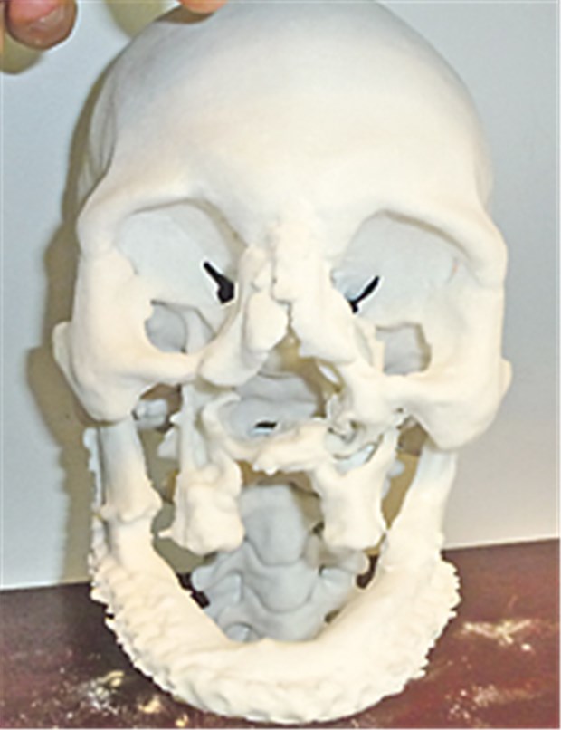 Schädel aus dem 3D-Drucker Vor Rekonstruktion und Gesichtstransplantation: 3D-Modell eines Schädels mit Defekten. Das Modell wurde mithilfe eines 3D-Druckers erstellt.