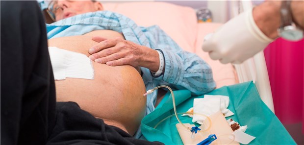 Vor der Aszites-Therapie sollte eine diagnostische Punktion erfolgen, um die Genese zu klären.