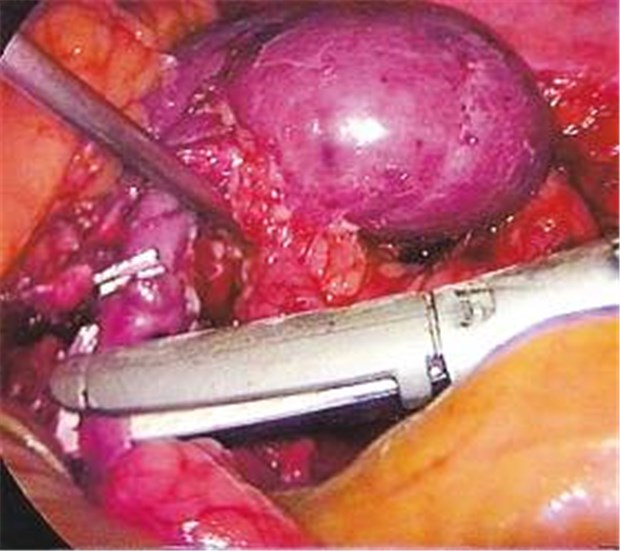 12 000 Patienten auf der Warteliste für fremde Organe - eine Zahl, die kaum kleiner wird Vor der Entnahme einer Spenderniere für die Transplantation. Auf fremde Nieren warten in Deutschland derzeit etwa 8000 Patienten.