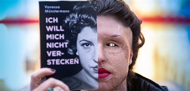 "Ab heute darfst du hässlich sein" Vor und nach dem Angriff: Vanessa Münstermann versteckt die Folgen des Säureangriffs auf sie nicht. Ihre Autobiografie widmet sie ihrer Tochter.