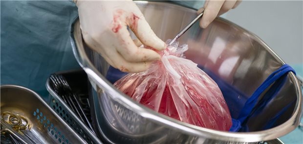 Arzt schneidet Tüte mit Organ auf.