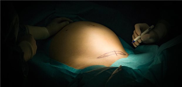 Vorbereitung zum Kaiserschnitt