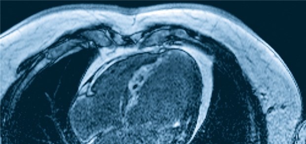 Therapie bei Myokardinfarkt - mit MRT und PET noch besser Vorderwandinfarkt in einer MRT-Aufnahme: Der geschädigte Bereich des Herzens erscheint weiß (länglicher weißer Streifen mitten im Herzmuskel), weil das Kontrastmittel darin hängen bleibt.