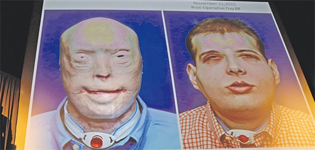 Ein neues Gesicht für den Feuerwehrmann Vorher, nachher: Bei der Präsentation der Ergebnisse der geglückten Gesichtstransplantation können sich alle vom Erfolg der Op überzeugen.
