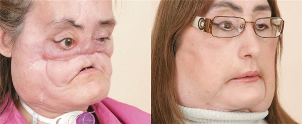 Erste Bilder nach Gesichtstransplantation in den USA Vorher - nachher: Vor Transplantation wurden bereits Wangenknochen aus Rippen und Oberkiefer aus Beinknochen aufgebaut.
