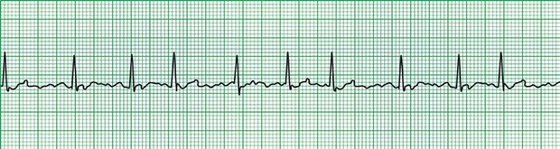 Vorhofflimmern im EKG.