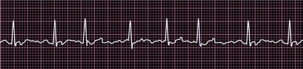 Wirken Statine gegen Vorhofflimmern? Vorhofflimmern im EKG. Typisch für diese häufigste Herzrhythmusstörung sind die unregelmäßig einfallenden QRS-Komplexe: absolute Arrhythmie.