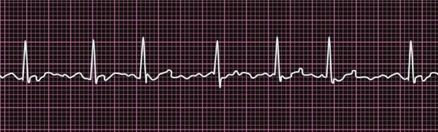 Was hilft bei Vorhofflimmern und Herzschwäche am besten? Vorhofflimmern im EKG. Typisch für diese im klinischen Alltag häufigste Herzrhythmusstörung sind die unregelmäßig einfallenden QRS-Komplexe: absolute Arrhythmie.