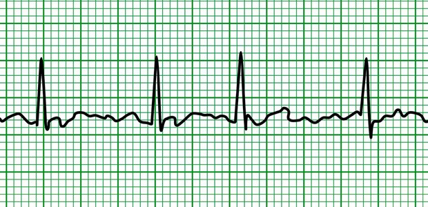 Vorhofflimmern - Prävalenz wird sich bis 2060 verdoppeln Vorhofflimmern nimmt mit dem Alter zu; jetzt gibt es aktuelle Hochrechnungen zur Prävalenz in EU-Ländern in den kommenden Jahrzehnten.