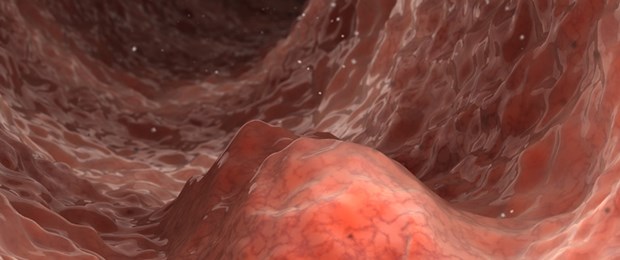 Vitamin D zur Darmkrebs-Prävention? Vorsicht Darmkrebs: Manche Menschen profitieren offenbar von der Prävention mit Vitamin D.