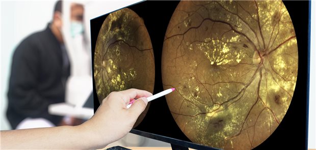 Check-up der Retina eines Patienten, der an diabetischer Retinopathie erkrankt ist.