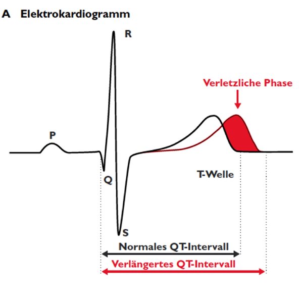 Chloroquin gegen das Coronavirus – Mehr Schaden als Nutzen? Während der Verlängerung des QT-Intervalls beim Long-QT-Syndrom besteht eine Phase erhöhter elektrischer Empfindlichkeit des Herzens.