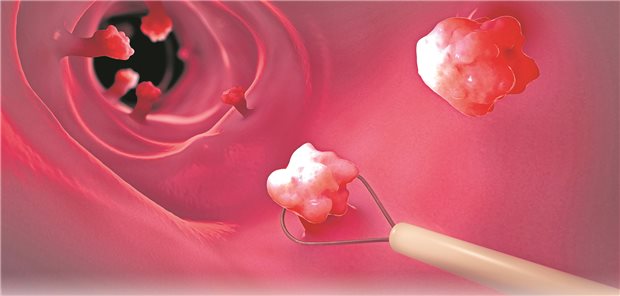 Während einer Koloskopie können verdächtige Polypen direkt entfernt werden (3D-Illustration).
