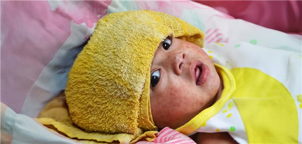 Während fast alle Kinder in Deustchland eine Erst-Impfung gegen Masern erhalten, erfolgt die zweite - wenn überhaupt - häufig erst nach dem zweiten Lebensjahr. 