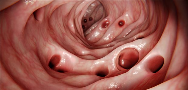 Wann ist bei einer Divertikulitis eine konservative Therapie noch ausreichend? Wann ist eine Op ratsam? Empfehlungen hierzu gibt nun eine S3-Leitlinie.