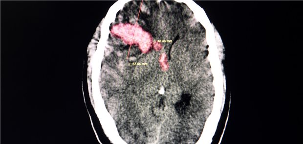 CT-Aufnahme des Gehirns eines thrombozytopenischen Patienten mit einem großen Blutgerinnsel im rechten Frontalbereich aufgrund einer intrazerebralen Blutung.