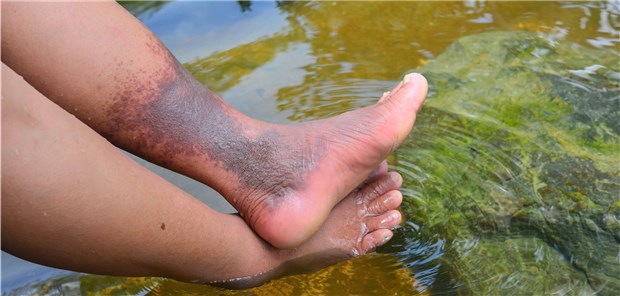 Warme Fußbäder beschleunigen die Heilung nach Tiefer Venenthrombose. mamsizz / stock.adobe.com