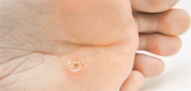 Needling nicht besser als Kürettage Warze: Beim Needling wird mit einer Hohlnadel tief in das verhornende Gewebe gestochen.