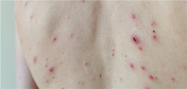 Was auf den ersten Blick aussieht wie Windpocken, könnten auch Affenpocken sein. Das lässt sich in einem Speziallabor, etwa am RKI, klären.