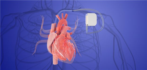 Dreidimensionale illustration eines implantierten Kardioverter-Defibrillator in einer menschlichen Herzvene.