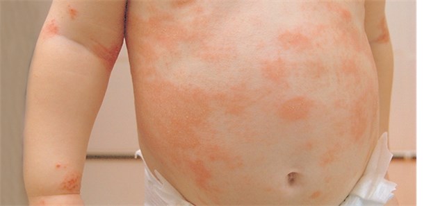 Dermatologische Diagnose klappt auch per Handyfoto Was hat mein Kind? Ein Handyfoto, über eine spezielle App an den Arzt geschickt, könnte Besuche beim Dermatologen überflüssig machen.