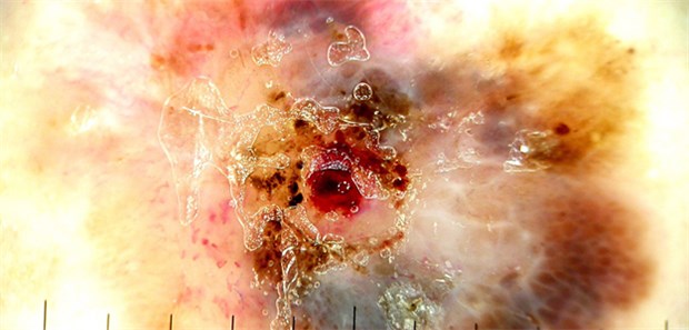 Eine Woche im Zeichen der Hautkrebs-Aufklärung Was hier aussieht wie eine vom Hubble-Teleskop aufgenommene Galaxie ist die vergrößerte Aufnahme eines superfiziell spreitenden Melanoms.