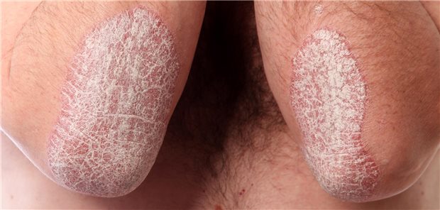 Was sind die Folgene eines Medikamentenwechsels bei Psoriasis? Eien Metaanalyse gibt Aufschluss.