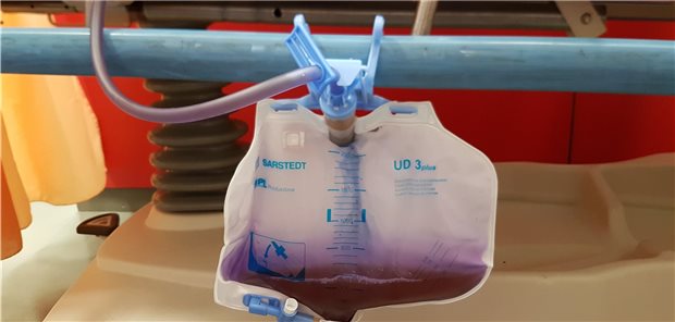 Lila gefärbter Urinbeutel: Was steckt hinter dem „Purple Urine Bag Syndrom“?