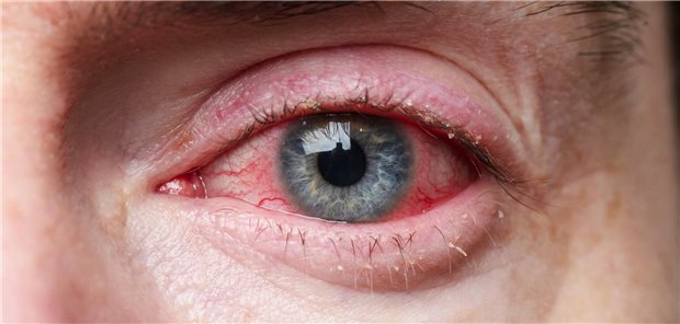 Gerötetes Auge mit einer Lidrandentzündung.