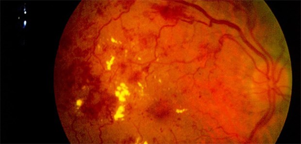 Mit Smartphones im Kampf gegen Blindheit Wegen der Gefäße-Lecks sehen Patienten mit Diabetischer Retinopathie verschwommen, doppelt, kontrastarm, flottierende Flecken.