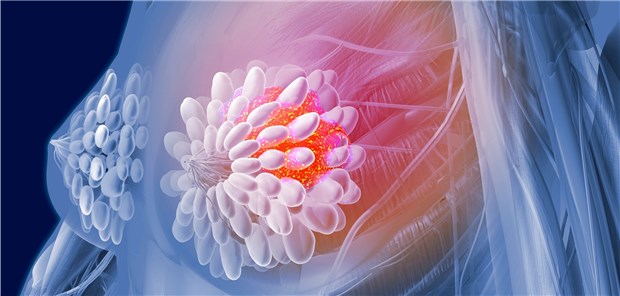 Wegen eines Verdachts auf Brustkrebs haben Ärzte im Jahr 2014 bundesweit 74.224 chirurgische Eingriffe in 817 Kliniken durchgeführt.