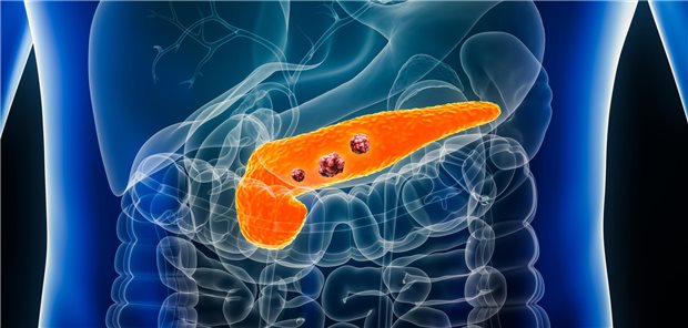 Medizinische Illustration von Pankreaskarzinomen