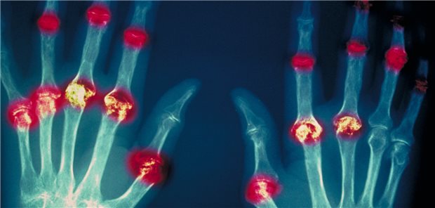 Weiter aktive Rheumatoide Arthritis – welcher Laborparameter gibt die Krankheitsaktivität möglichst genau wieder?