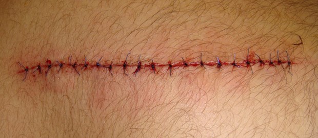 Heilung auch ohne Verband Welche Auflage zum Verbinden einer chirurgischen Wunde verwendet wird, sollte zum Beispiel von ihrer Fähigkeit abhängen, Exsudat zu absorbieren.