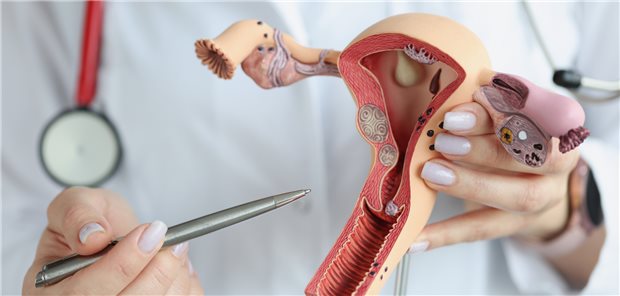 Welche Optionen der Therapie bei Neoplasien der Cervix uteri gibt es? Mithilfe eines Modells lässt sich Vieles leichter erklären.