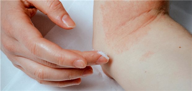 Welche topische Behandlung ist bei einer atopischen Dermatitis am nebenwirkungsärmsten? (Symbolbild)