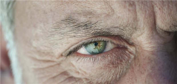 Welchen Einfluss haben Acetylcholinesterase-Inhibitoren zur Behandlung bei Morbus Alzheimer auf die Entwicklung einer altersbedingten Maculadegeneration? Dieser Frage ging eine US-Veteranen-Studie nach.